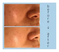 本日空きあり🌰🧡特別メニュー✨毛穴ケア、、脱マスクに1日2名限定💎