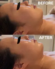 プレミアム女優小顔コース（クレンジング・洗顔→高周波→リジェセル→炭酸パック→マッサージ→幹細胞でお仕上げ）