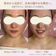 【剥離なし✨角質ケア】ツヤ肌バクテリウムピール＋デコルテケア付♡うる肌＆首元スッキリ✨