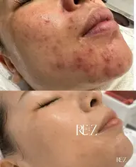 【2名限定🌈】日本上陸🇯🇵✨🇰🇷天然微細針で内側からつるん肌✨毛穴/ニキビ/シミシワたるみ