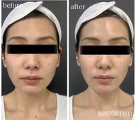 顔キャビ痩身☆モニター募集　3800円税込