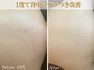 【背中美人モニター】背中（上部）ララピール！ニキビ、ざらつきケアにおすすめ！※現金払いのみ