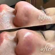 初回体験✨【肌質改善コース】J-PEEL角質除去+ハイドロ毛穴洗浄+高保湿パック