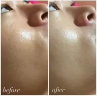 当店人気No.2メニュー✨️ 【 毛穴・美肌トーンupケア 】 REVIハーブピーリング🌿