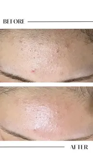 学割U24限定!肌質別で選べる大人気ピーリング🌿【飛び出る毛穴吸引+毛穴ケアorニキビケアor乾燥ケア】