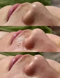 溶ける角栓【毛穴吸引】引き締めパック＆鎮静パック付き🥸フルフェイス全顔毛穴サッパリ¥6980✨