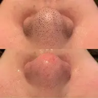 毛穴エクストラクション＋エレクトロクレンジング＋パック＋導入（デコルテマッサージ付）👃🏼