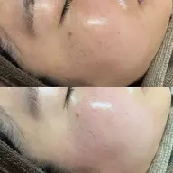 艶肌フェイシャルワックス全顔×韓国水光アンプル導入　8980円