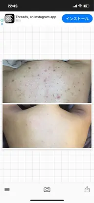 人気No.1👑ハイドラ(毛穴洗浄)+🌿ハーブピーリング(剥離あり)🌿背中or腰or二の腕orお尻orデコルテなど