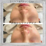 ハリツアUPならWIQ0 水光ピール！