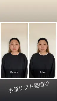 1回で変化がわかる小顔矯正/たるみ、浮腫み、リフトアップ