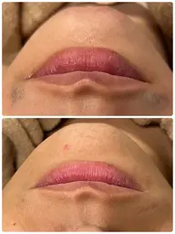 👨🏻👱🏽‍♂️1日2名限定✨メンズヒゲ脱毛🧡爆抜け付き🤍