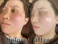 🫧‪復元パック🫧‪  肌のくすみ、赤み、ニキビ跡、シミ