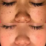 【期間限定価格🉐】《ニキビ跡/シミ/赤み改善》光フォト+超音波毛穴洗浄