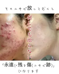【本気改善】剥離あり韓国水光肌ハーブピーリング　27,500→8,800円