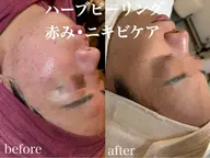 ニキビケア⭐️鼻穴洗浄+ハーブピーリング+人幹細胞高濃度パック付22,000→8980