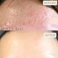 《本格ニキビケア4ヶ月コース》施術60分