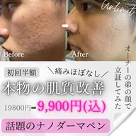 【初回/凸凹肌ケアに◎】肌質改善/毛穴洗浄×幹細胞エクソ導入×ナノダーマ約60分