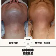 ミニモ限定価格✨ヒゲ脱毛(首、ほほ込み)