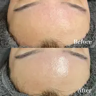 🍋【ニキビ毛穴シミに】REVIハーブピーリング《陶肌トリートメント》➕VCFリキッド 0.8ml