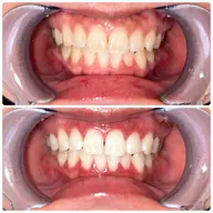 ✨ご新規様限定価格✨15分×2回照射 8800円→1980円🩵