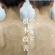 【背中ニキビケア🌿】剥けないハーブピーリングピーリング(肩​〜​腰までしっかり)＋美容液導入付き　定価22,000円