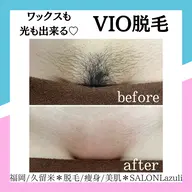 【新規女性/大人女性の身だしなみ/介護脱毛】VIOワックス+光脱毛体験¥8980