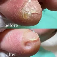 【副爪ケア】小指の爪横にある爪みたいなモノ💡キレイにします💁♀️