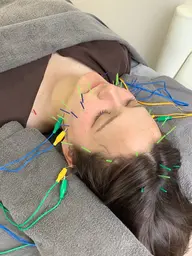 【🉐平日限定🉐】美容鍼(45分)※写真掲載+口コミご協力いただける方限定※