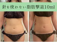 👑人気NO.1👑針を使わない脂肪撃退‼️後戻りゼロ🫶 +ハイパーナイフEX 🔥 【お好きな箇所1部位集中】