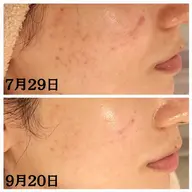 ハーブピーリング+高濃度美容液導入　60分　￥3,300オフ