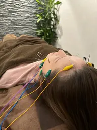 人気No.1🔥たるみ、リフトアップ、浮腫みに特化✨電気を流す美容鍼 通常料金12100円→7700円※カウンセリング込