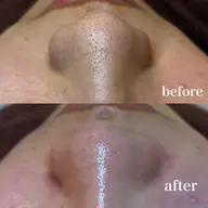 🫧ハイドラフェイシャル（毛穴洗浄）🫧先着10名限定価格　❗️動画撮影可能・口コミ記載❗️