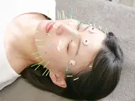 【1日1名限定！】✨ピーリング効果◎✨美容鍼プレミアムコース 16500→11000