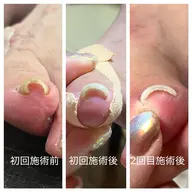 【巻き爪矯正(45分/1本〜)痛みの原因となる角質の除去、巻きの緩和をお手伝い。地味に痛い。そんな日々に終止符を!