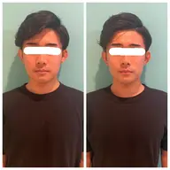 【小顔ケア】小顔EMS+ポレーション導入 ￥5,980‐