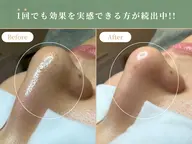 【毛穴ケアプログラム】黒ずみ/凹凸/開きなどのお悩みから解放