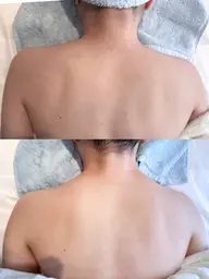 【ウエディング前必見】肌育成ハーブピーリング ［背中］ツルと綺麗なお背中に🫧