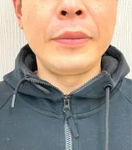 【メンズ脱毛】人気のヒゲ脱毛🎉ヒゲ剃り要らずのキレイ肌へ✨