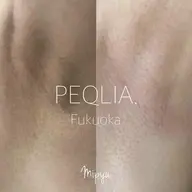 【最新メラニンケア/Mipyu】脇/アフタークリーム1ヶ月分付