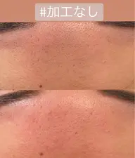 おでこのワックス脱毛