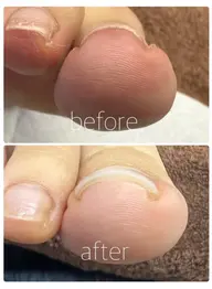 ✨限定✨【フット】巻き爪ケアコース