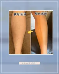 【男性限定】最先端脱毛機械！剛毛脇毛×ふくらはぎ脱毛×腕脱毛　気になる部位3部位まとめてケア
