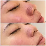 お悩み「毛穴」撃退コース