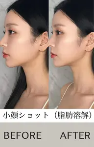 【二重顎を解消◎速攻小顔】脂肪に直接アプローチ！痛みなしでスッキリ小顔へ。リフトアップ効果も◎最新の小顔施術です！