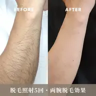 全身脱毛【顔・VIO込み】保湿成分配合ジェル使用