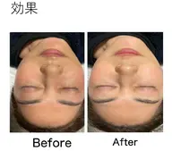 優しい剥離なしのハーブピーリング➕人幹細胞美容液をたっぷり入れこんでいきます【現金かpaypay】