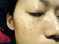 仮予約お得🉐🌈シミケア☺️シミ取り低周波分解　レーザーより痛くないソフィアカロンでインスタ検索シミ取り動画あります♪