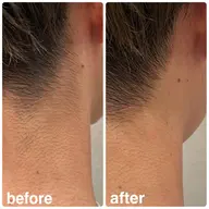 🌟襟足脱毛🌟一回で抜けた!減った!が実感できる脱毛