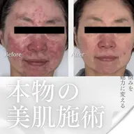 敏感肌、トラブルが出てしまったお肌、専用コース